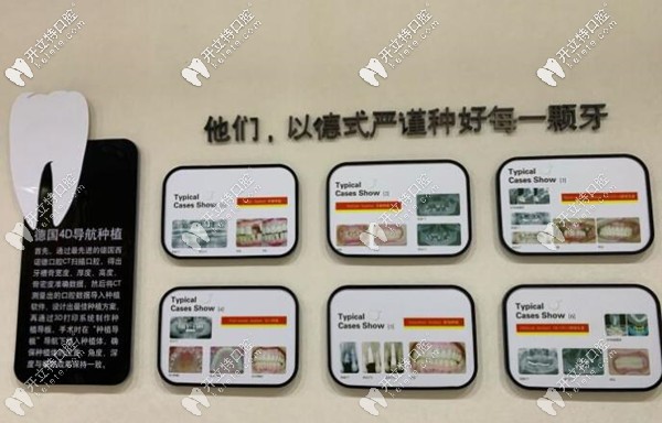 南京雅度口腔德国4D微创导板种植牙