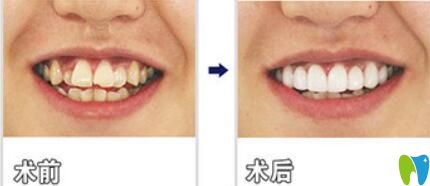 南京美莱生态烤瓷牙修复牙齿案例