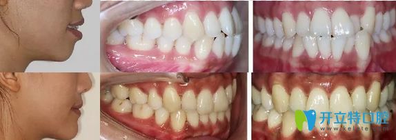 南京牙仙子口腔隐形牙齿矫正案例