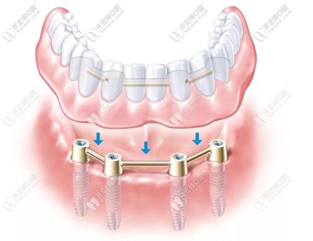 all-on-4种植牙技术