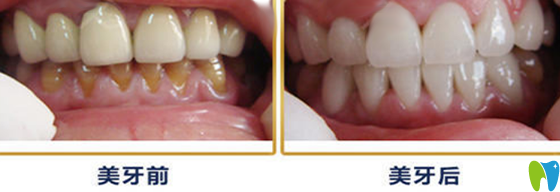 3D瓷贴面牙齿修复术前术后对比案例