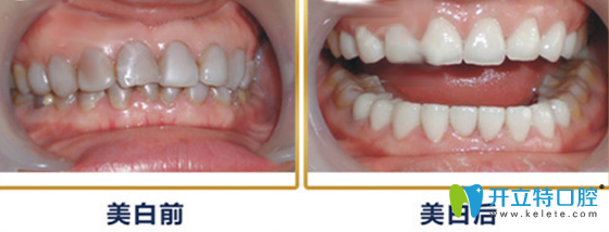 牙卫士口腔班氟斑牙治疗案例前后效果对比