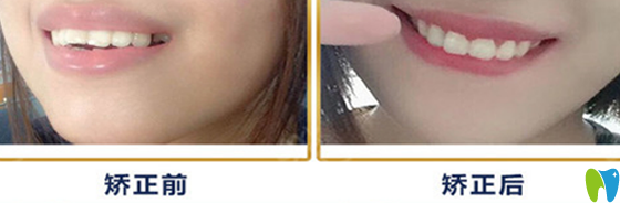 重庆牙卫士口腔真人龅牙矫正案例前后效果对比图