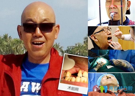 重庆牙博士口腔牙齿种植过程及前后效果对比图