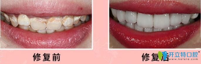 重庆茁悦口腔瓷贴面修复牙齿案例前后效果对比