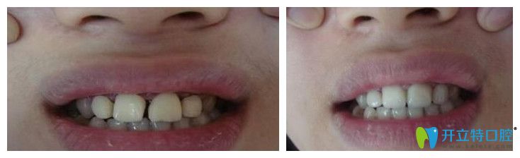 武汉欧燕口腔牙齿美容冠修复前后对比图