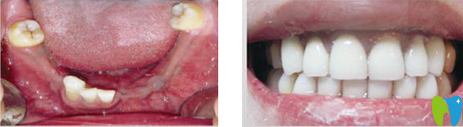 长沙雅美口腔种植牙前后效果对比图