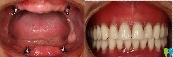 长沙齿邦口腔高难度全口种植牙案例