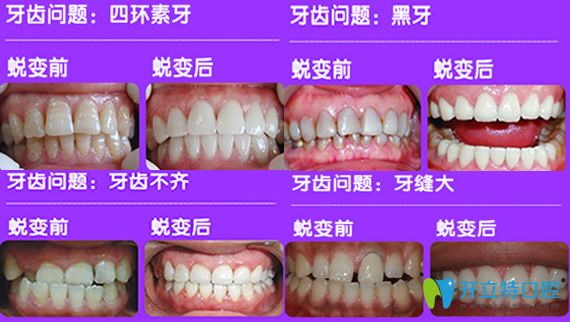 惟真口腔DSD数字美学瓷贴面案例治疗前后效果对比
