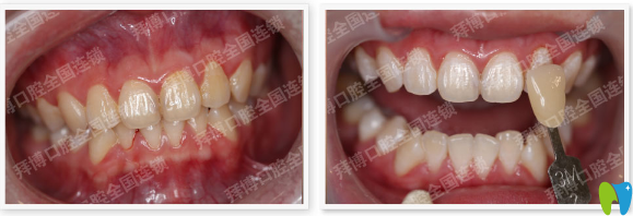 佛山拜博口腔牙齿美学修复案例