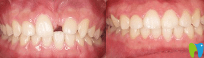 宁波拜博拜尔口腔种植牙效果对比图