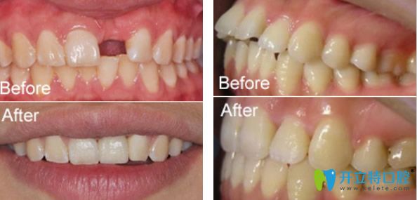 维乐口腔单颗牙缺失种植+龅牙正畸效果案例