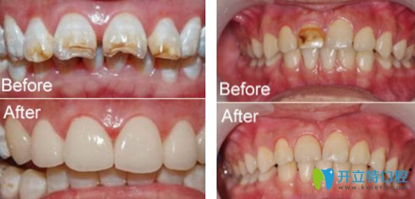 维乐口腔牙齿缺损及色素牙的美白修复效果