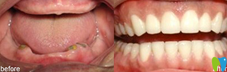 可恩口腔全口牙种植前后效果对比图