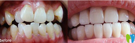 青岛可恩口腔牙齿矫正效果对比图