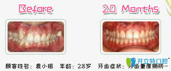 沈阳欢乐口腔隐适美矫正案例