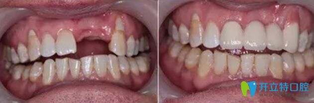 属于全好口腔的单颗牙种植案例对比