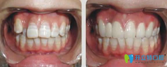 合肥世佳口腔牙齿矫正前后对比图