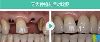 厦门瑞尔齿科种植牙前后效果对比图