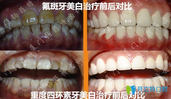 铂菲特口腔氟斑牙+重度四环素牙美白治疗前后对比案例