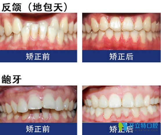 福州晶美口腔牙齿矫正案例效果