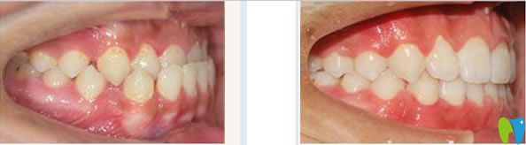 南宁柏乐口腔门牙反颌矫正前后对比案例