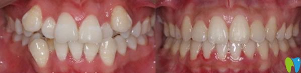 沙医生口腔牙齿矫正前后效果对比图