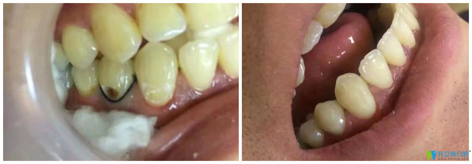 雅乐口腔补牙案例效果对比图