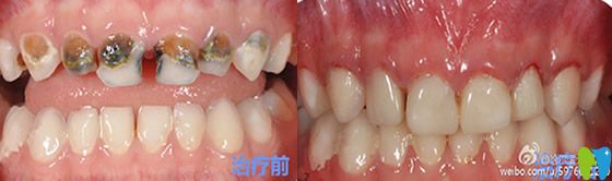 哈尔滨大象口腔乳牙预成冠治疗术前术后对比案例