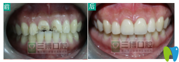 石家庄三博口腔烤瓷牙案例效果