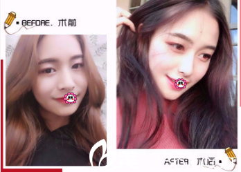北京玲珑梵宫整形面部吸脂案例
