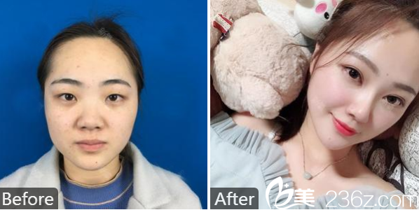 广州南方医院整形美容外科冯传波双眼皮隆鼻和自体脂肪填充案例