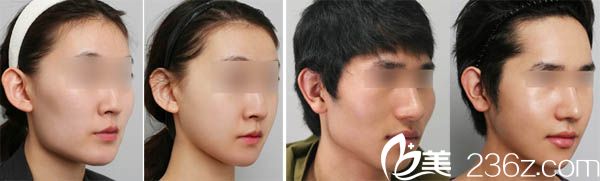 广东省第二人民医院整形美容科下颌角整形案例