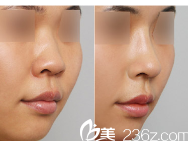 广东省第二人民医院整形美容科徐翔自体软骨垫鼻尖案例