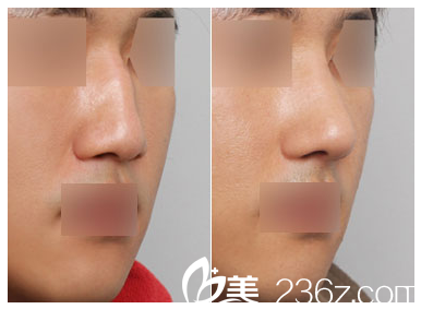 广东省第二人民医院整形美容科徐翔鼻综合隆鼻案例
