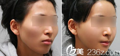 广东省第二人民医院整形美容科颧骨前内骨折手术案例效果图
