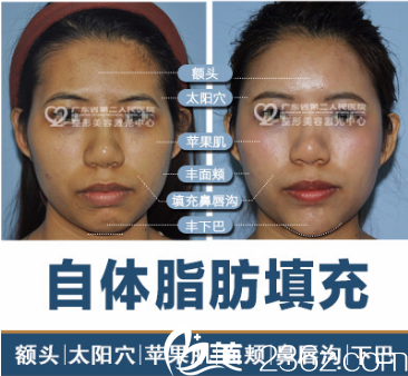 广东省第二人民医院整形美容科徐翔自体脂肪填充案例