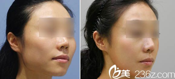 广东省第二人民医院整形美容科徐翔瘦脸针治疗咬肌肥大案例
