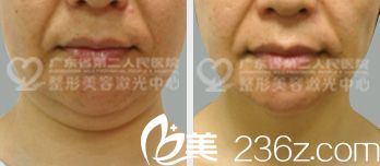 广东省第二人民医院整形美容科孙中生颈部吸脂案例