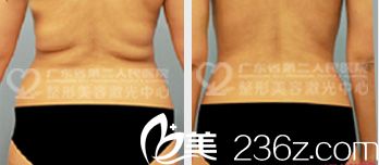 广东省第二人民医院整形美容科孙中生背部吸脂案例图片