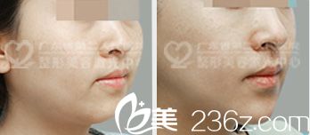 广东省第二人民医院整形美容科孙中生面部吸脂案例对比图