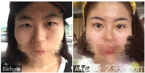 广州中山医科大学家庭医生整形美容医院于国中双眼皮案例图