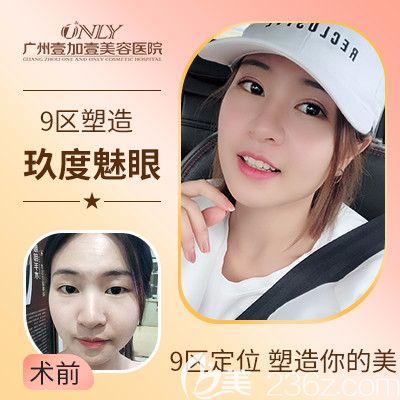 广州壹加壹项美莲玖度美眼双眼皮案例