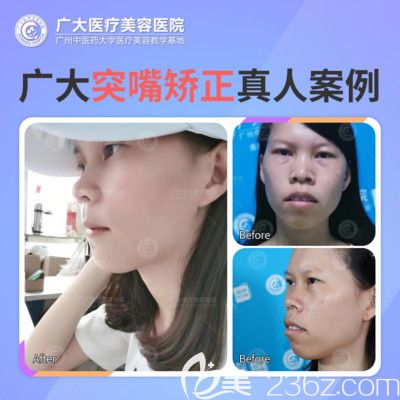 广州广大医院何锦泉做的正颌手术案例