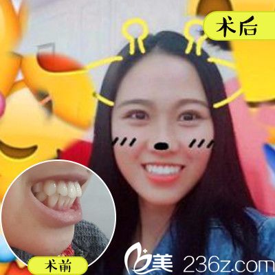 深圳美莱口腔医院金属托槽牙齿矫正案例