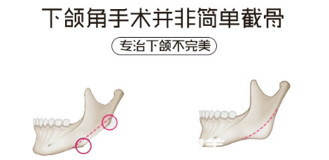 深圳华侨医院整形科下颌角整形