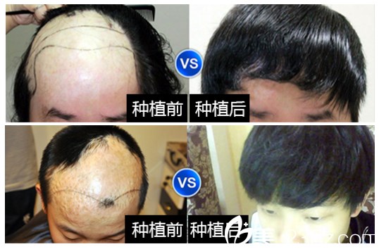 深圳雍禾植发医院疤痕种植案例图