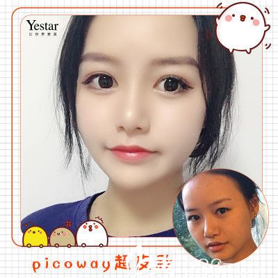 深圳yestar整形医院莎综合美眼双眼皮案例