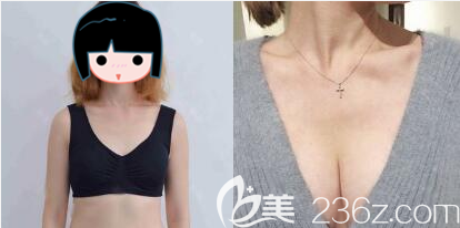 成都美莱吴江山假体丰胸术前术后对比图