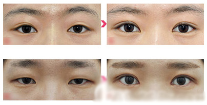 珠海九龙医院整形美容科双眼皮案例